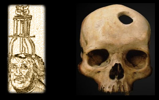 Ancient trepanation apparatus, and the result...